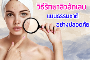 วิธีรักษาสิวอักเสบ-แบบธรรมชาติอย่างปลอดภ